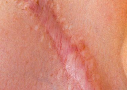 اكتشاف جديد يمكن أن يساعد في القضاء على الندوب