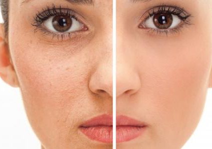 حب الشباب علامة مرض خطير