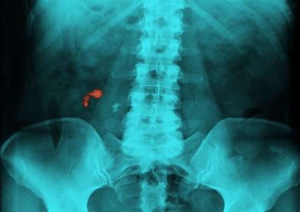 "اختراق طبي" قد يضع حداً لأمراض الكلى