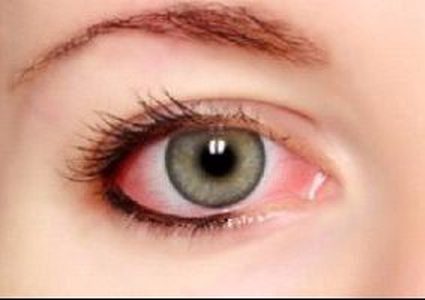 أسباب الرمد الربيعى وكيفية تخفيف أعراضه