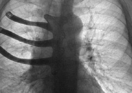 طبع قفص صدري ثلاثي الأبعاد لمريض في بريطانيا