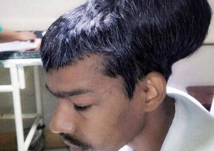 عملية إستئصال أكبر ورم دماغي في العالم!