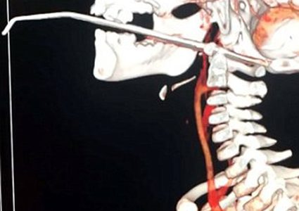 إبرة 14 سم تخترق وجه طفل بالصين (صور)