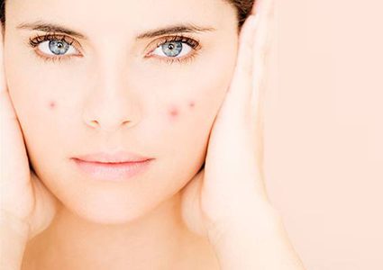 تحفيز الأطعمة الحارة لحب الشباب حقيقة أم خرافة!