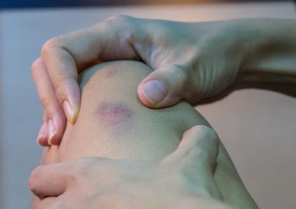 ظهور الكدمات على الجسم هل هو خطر على الصحة!