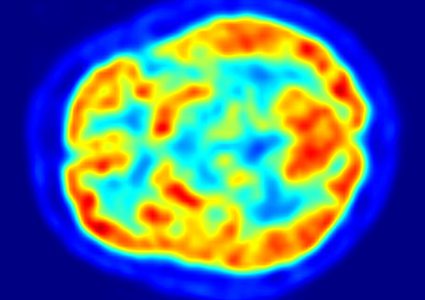 الاكتئاب قد يغير شكل الدماغ على المدى الطويل