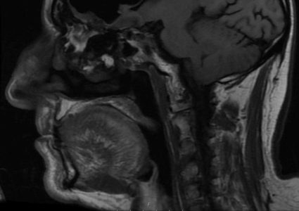 رجل عاش 84 عاما بـ "نصف دماغ" دون أن يدري!