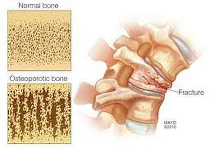 كثافة العظام تكشف إصابة السيدات بأمراض القلب!