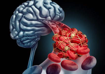 إصابة سيدة بالسكته الدماغية لسبب غريب جداً