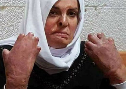 نقل الأسيرة جعابيص لمستشفى "هداسا"