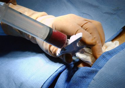 هل تنجح عملية زراعة النخاع الشوكي في إنقاذ مرضى التصلب المتعدد ؟