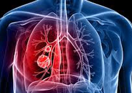 علاج سرطان الرئة بين العمليات الجراحية والعلاج الإشعاعي