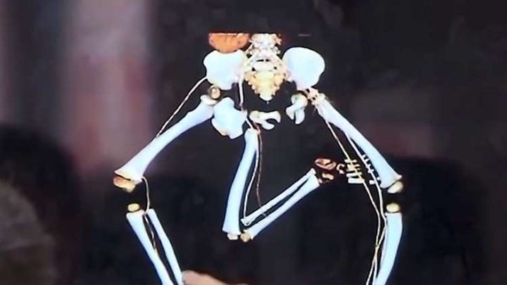 جراحة معقدة لتخليص طفل صيني من "توأمه الطفيلي"