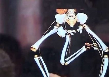 جراحة معقدة لتخليص طفل صيني من "توأمه الطفيلي"