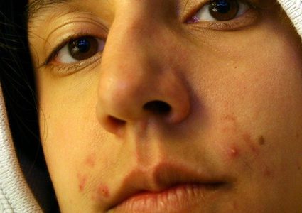 إزالة حبوب الشباب بالضغط عليها لماذا يجب تجنبه؟