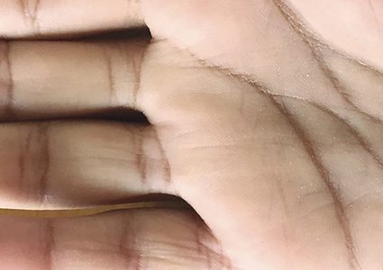 نتوء زرقاء في اليد سبب في مرض قلبي