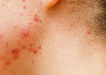 باحثون: البكتيريا السبب الرئيسي في حب الشباب