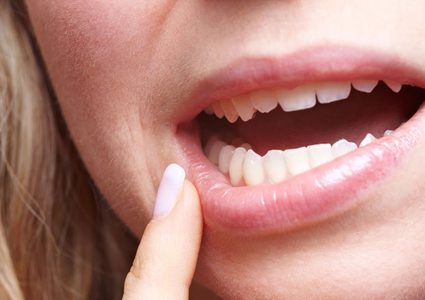 ماذا تعني البقع البيضاء على اللثة؟
