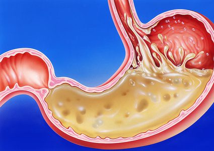 نصائح للتخلص من حرقة المعدة