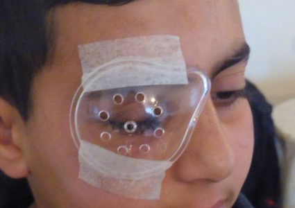 الطّفل النوباني... فقد عينه اليُمنى جرّاء عيارٍ مطاطيّ