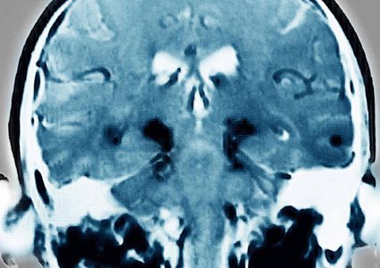 جروح الدماغ تؤدي إلى الإصابة بمرض الباركنسون