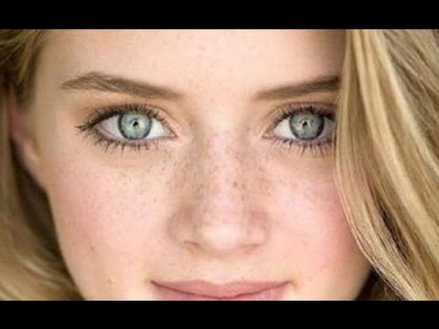 ماذا يستطيع "نمش العين" أن يخبرك عن صحتك ؟