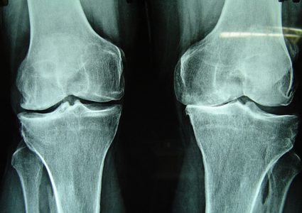 عالج التهاب المفاصل الروماتيزمي بشاي الكركم والزنجبيل