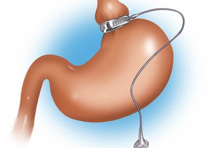 ما هي مخاطر عملية ربط المعدة ؟