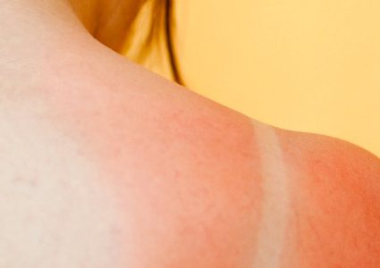 خبير يجب الحذر عند التعرض للشمس من سرطان الجلد