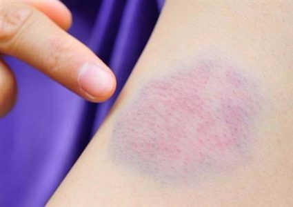 أسباب ظهور بقع زرقاء في الجسم