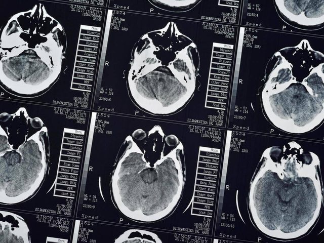 التصوير الجسيمي يعيد للإنسان حواسه المفقودة !