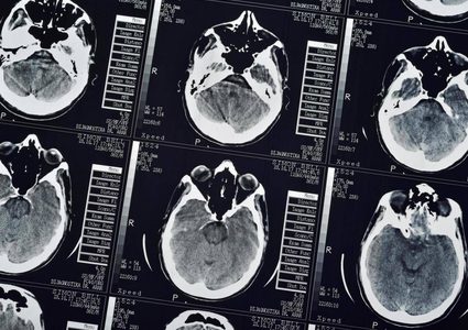 التصوير الجسيمي يعيد للإنسان حواسه المفقودة !