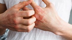 هل يمكن أن تستخدم البكتيريا في علاج الأكزيما ؟
