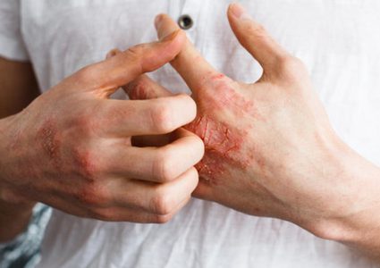 هل يمكن أن تستخدم البكتيريا في علاج الأكزيما ؟