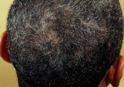 إفراط الاستجابة المناعية سبب في الشيب!