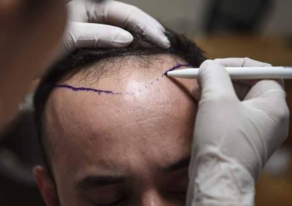 نمو الشعر بات ممكنا في 6 أيام لمن يعاني من الصلع