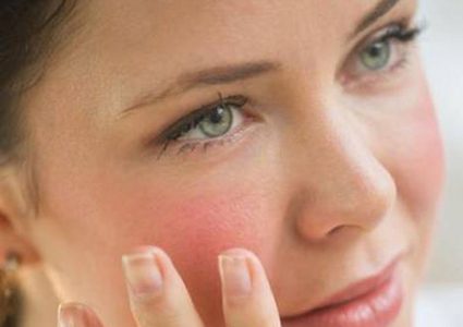 السمنة تزيد من أعراض الذئبة الحمراء لدى السيدات