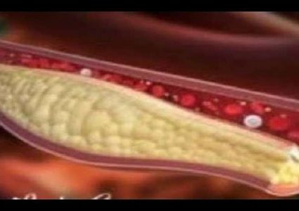 عوامل ترفع مستوى الكوليسترول في الدم