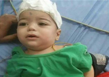 "معجزة طبية" تنقذ رضيعا من سيخ حديدي اخترق رأسه