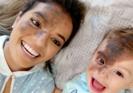 لمساندة ابنها نفسيًا.. أم ترسم "وحمة" على وجهها (صور)