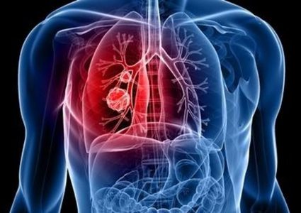 مفاجأة.. فحص دم تجريبي يرصد سرطان الرئة مبكراً