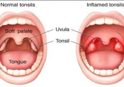 أسرع 4 مشروبات لعلاج التهابات اللوزتين!