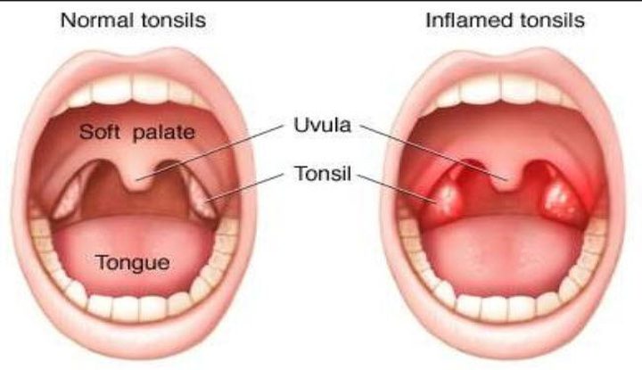 أسرع 4 مشروبات لعلاج التهابات اللوزتين!