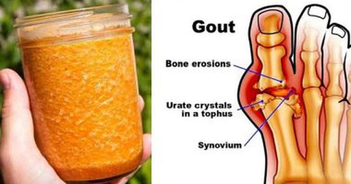 علاج النقرس بـ6 مواد طبيعية اعرفها وجربها