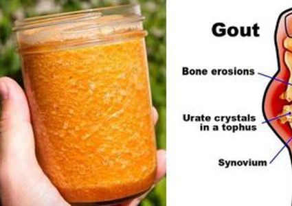 علاج النقرس بـ6 مواد طبيعية اعرفها وجربها