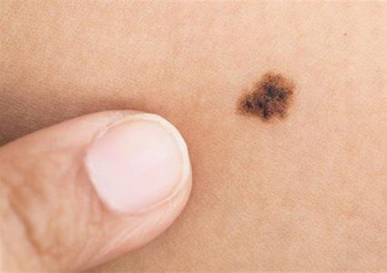 من هم الأكثر عرضة بالإصابة بـ سرطان الجلد؟