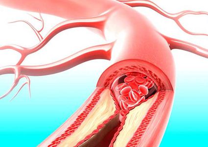 ما هي الطريقة التي ينصح بها العلم لتجنب الإصابة بالنوبة القلبية والسكتة الدماغية ؟