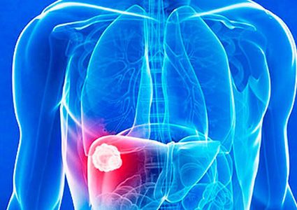 ما هي الأعراض المبكرة للإصابة بسرطان الكبد؟