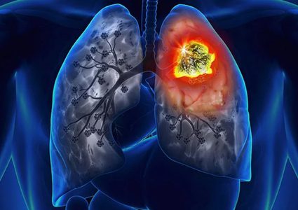 ما السبب وراء اصابة النساء بسرطان الرئة؟