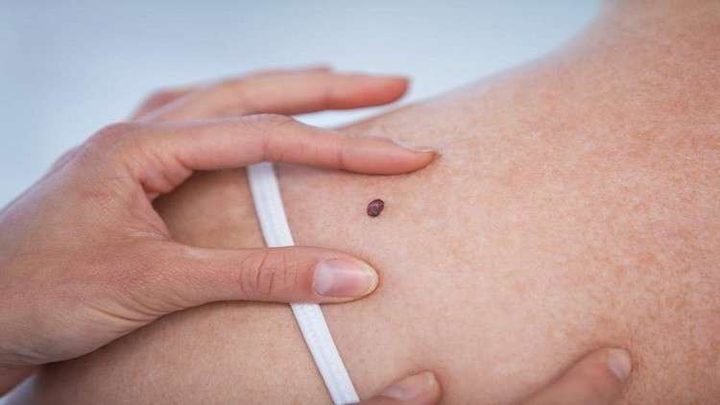 الميلانوما من العلامات المبكرة لهذا السرطان؟